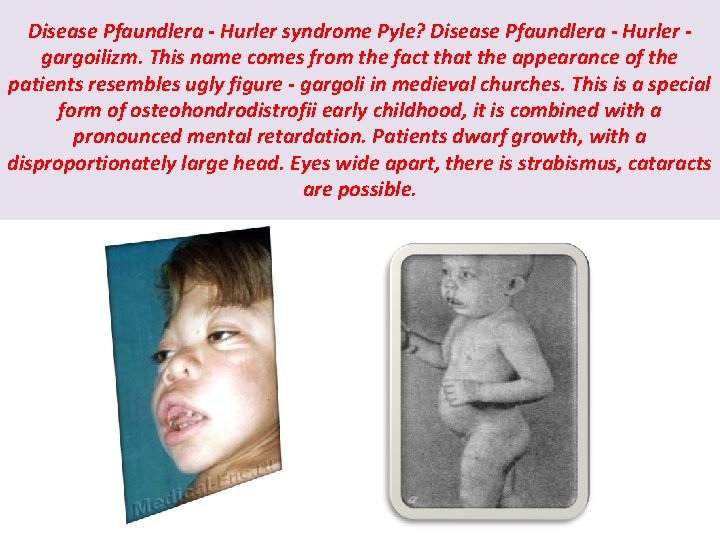 Disease Pfaundlera - Hurler syndrome Pyle? Disease Pfaundlera - Hurler gargoilizm. This name comes