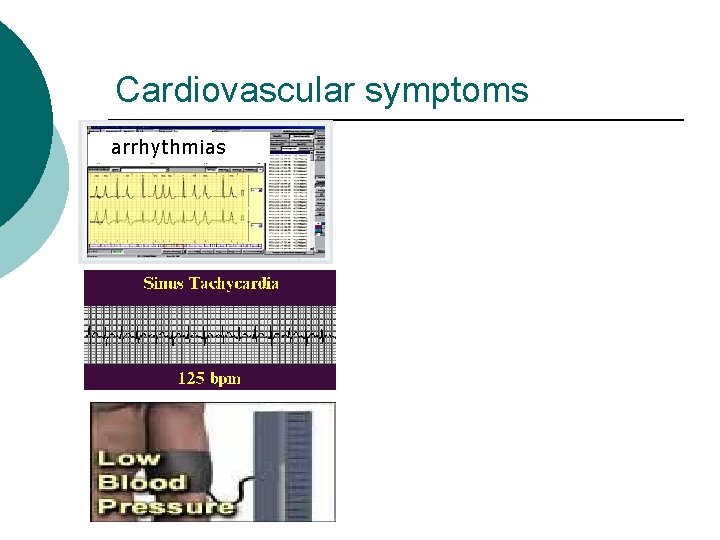 Cardiovascular symptoms arrhythmias 