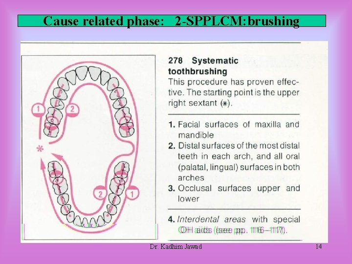 Cause related phase: 2 -SPPLCM: brushing Dr. Kadhim Jawad 14 Cause related phase: 2 -SPPLCM: brushing Dr. Kadhim Jawad 14