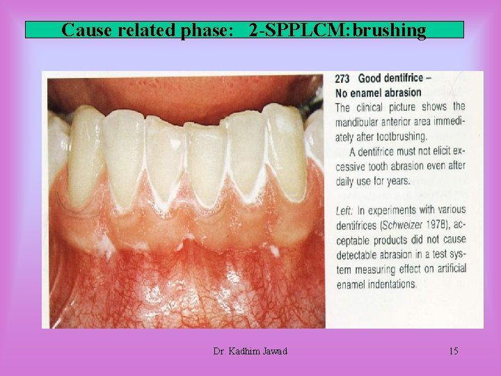 Cause related phase: 2 -SPPLCM: brushing Dr. Kadhim Jawad 15 Cause related phase: 2 -SPPLCM: brushing Dr. Kadhim Jawad 15
