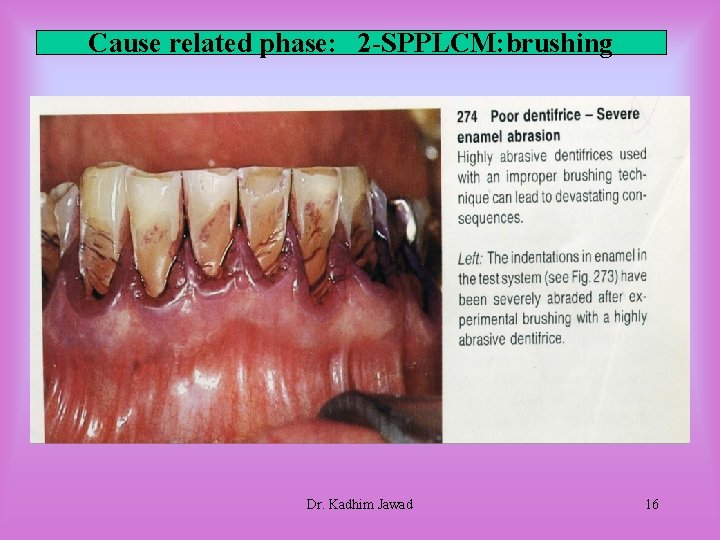 Cause related phase: 2 -SPPLCM: brushing Dr. Kadhim Jawad 16 Cause related phase: 2 -SPPLCM: brushing Dr. Kadhim Jawad 16