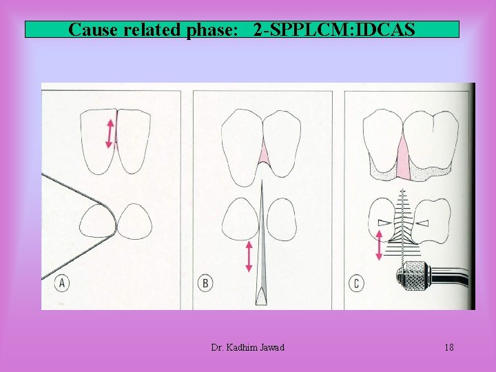 Cause related phase: 2 -SPPLCM: IDCAS Dr. Kadhim Jawad 18 Cause related phase: 2 -SPPLCM: IDCAS Dr. Kadhim Jawad 18