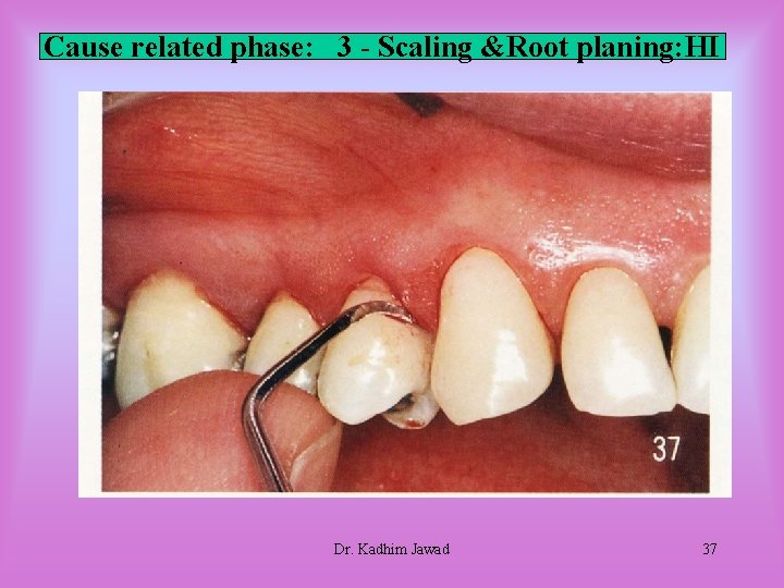 Cause related phase: 3 - Scaling &Root planing: HI Dr. Kadhim Jawad 37 Cause related phase: 3 - Scaling &Root planing: HI Dr. Kadhim Jawad 37