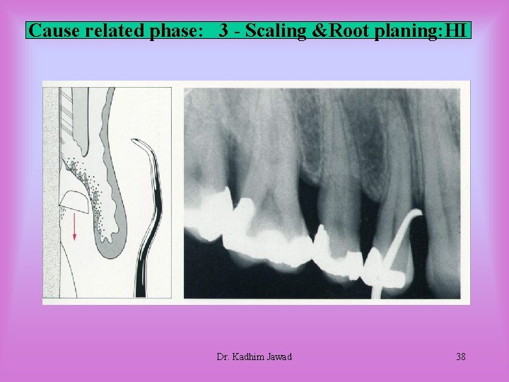 Cause related phase: 3 - Scaling &Root planing: HI Dr. Kadhim Jawad 38 Cause related phase: 3 - Scaling &Root planing: HI Dr. Kadhim Jawad 38