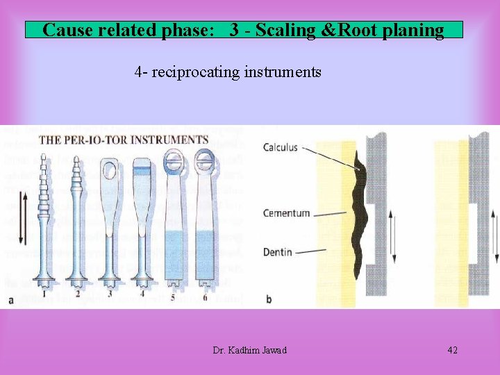 Cause related phase: 3 - Scaling &Root planing 4 - reciprocating instruments Dr. Kadhim Cause related phase: 3 - Scaling &Root planing 4 - reciprocating instruments Dr. Kadhim