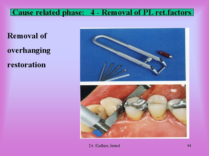 Cause related phase: 4 - Removal of PL ret. factors Removal of overhanging restoration Cause related phase: 4 - Removal of PL ret. factors Removal of overhanging restoration