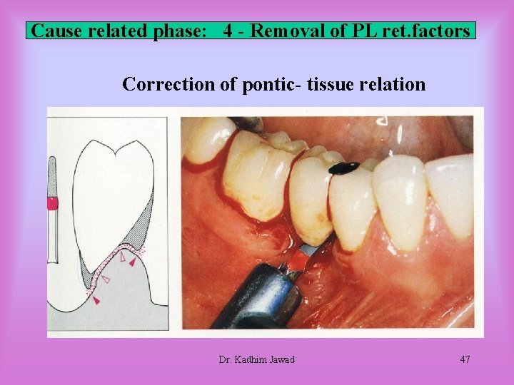 Cause related phase: 4 - Removal of PL ret. factors Correction of pontic- tissue Cause related phase: 4 - Removal of PL ret. factors Correction of pontic- tissue