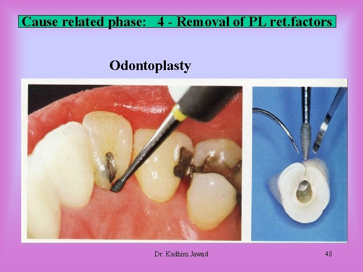 Cause related phase: 4 - Removal of PL ret. factors Odontoplasty Dr. Kadhim Jawad Cause related phase: 4 - Removal of PL ret. factors Odontoplasty Dr. Kadhim Jawad