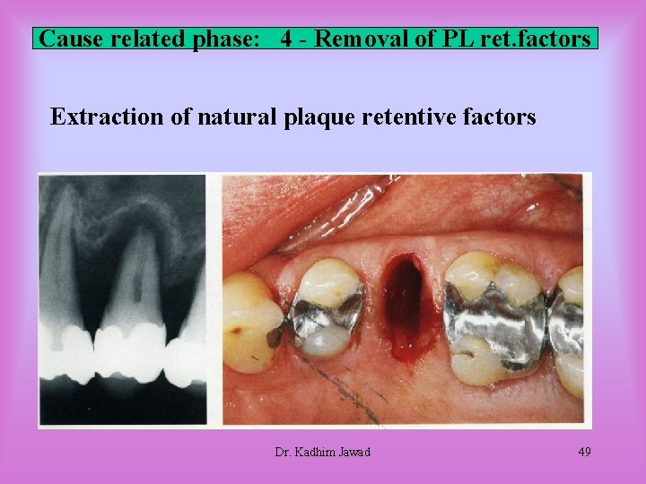Cause related phase: 4 - Removal of PL ret. factors Extraction of natural plaque Cause related phase: 4 - Removal of PL ret. factors Extraction of natural plaque