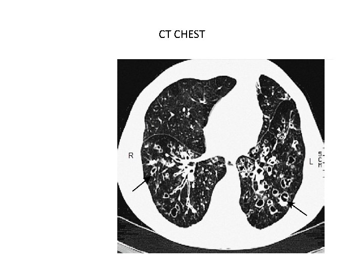 CT CHEST 