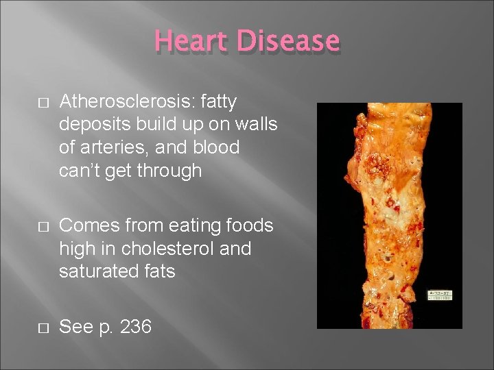 Heart Disease � Atherosclerosis: fatty deposits build up on walls of arteries, and blood