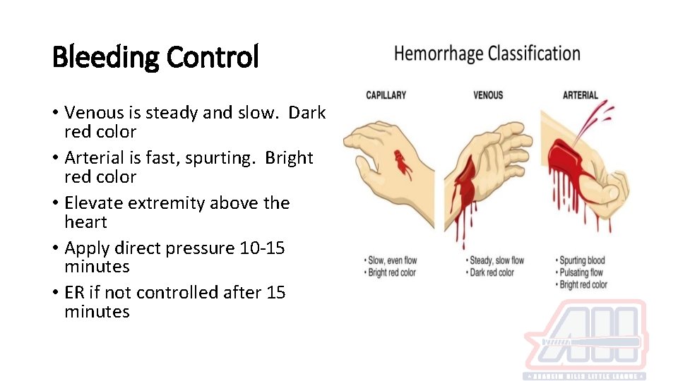 Bleeding Control • Venous is steady and slow. Dark red color • Arterial is