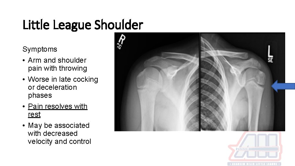 Little League Shoulder Symptoms • Arm and shoulder pain with throwing • Worse in