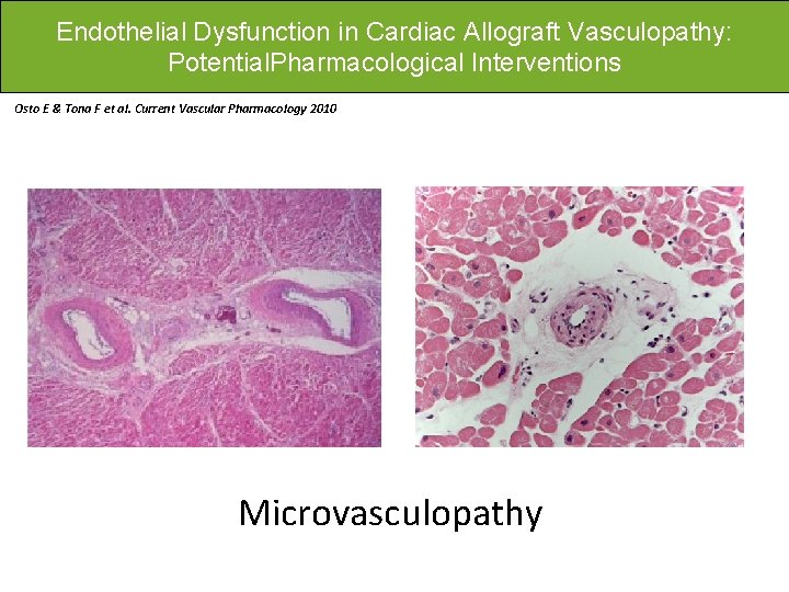 Endothelial Dysfunction in Cardiac Allograft Vasculopathy: Potential. Pharmacological Interventions Osto E & Tona F