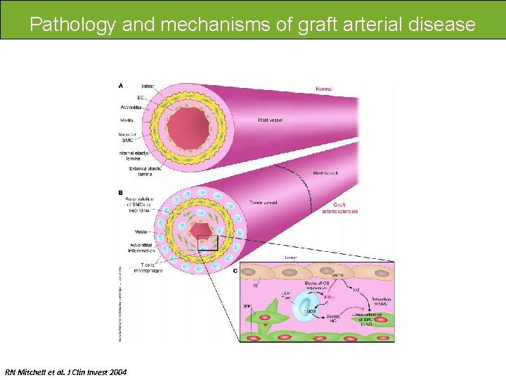 Pathology and mechanisms of graft arterial disease RN Mitchell et al. J Clin Invest