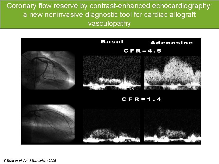 Coronary flow reserve by contrast-enhanced echocardiography: a new noninvasive diagnostic tool for cardiac allograft