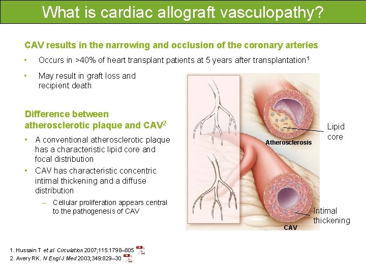 What is cardiac allograft vasculopathy? CAV results in the narrowing and occlusion of the