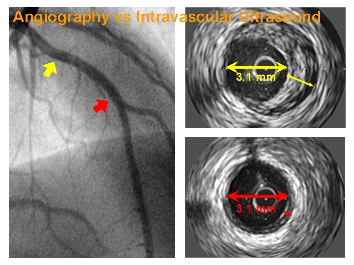 Angiography vs Intravascular Ultrasound 3. 1 mm 