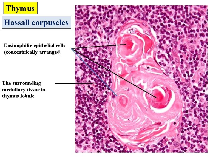 Thymus Hassall corpuscles Eosinophilic epithelial cells (concentrically arranged) The surrounding medullary tissue in thymus