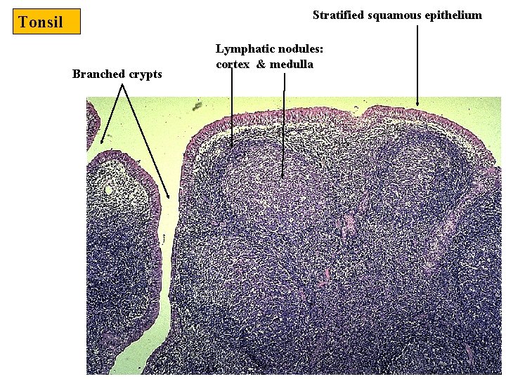 Stratified squamous epithelium Tonsil Branched crypts Lymphatic nodules: cortex & medulla 