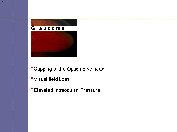 5 Glaucoma Cupping of the Optic nerve head Visual field Loss Elevated Intraocular Pressure