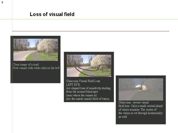 6 Loss of visual field Clear image of a road. Note runner with white