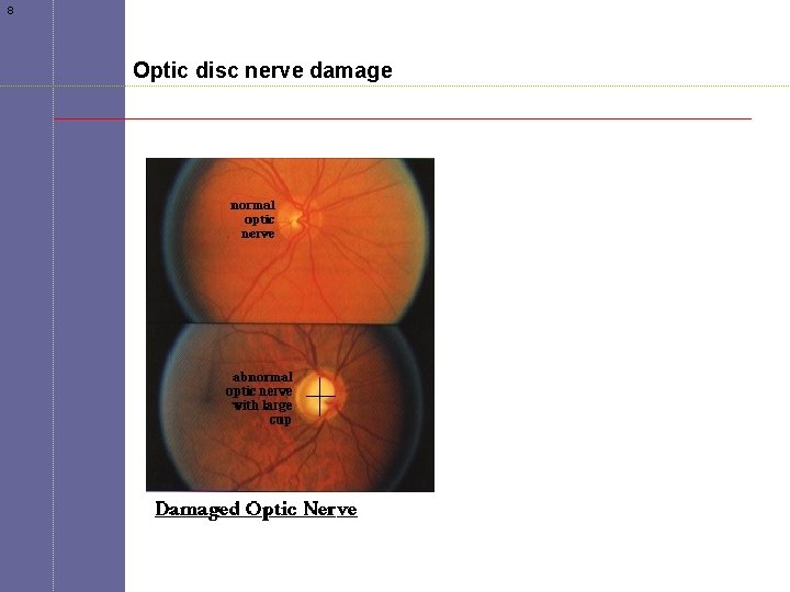 8 Optic disc nerve damage 