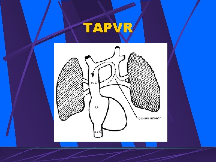 TAPVR 