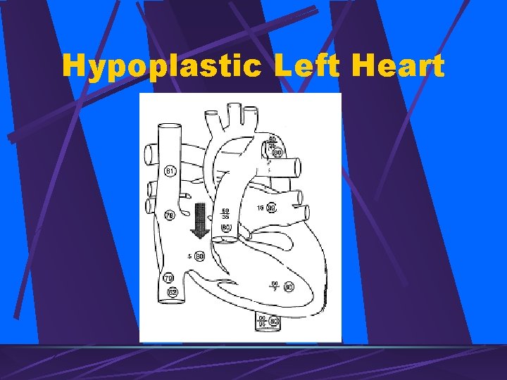 Hypoplastic Left Heart 