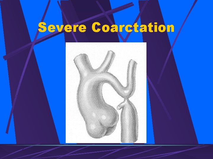 Severe Coarctation 