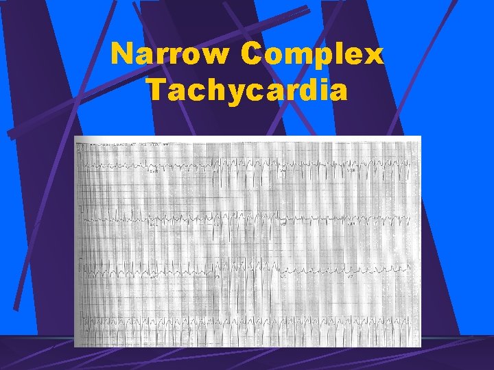 Narrow Complex Tachycardia 