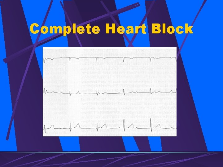 Complete Heart Block 