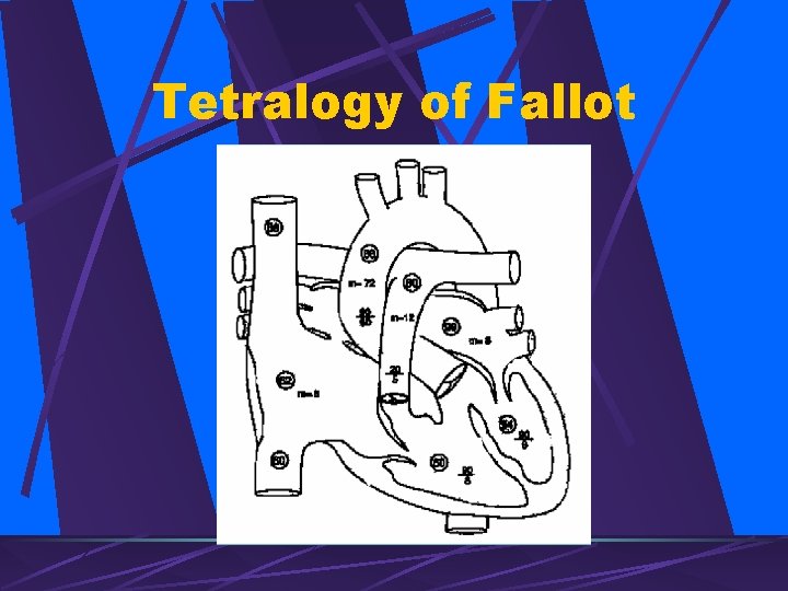 Tetralogy of Fallot 