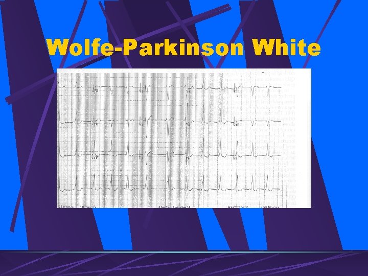 Wolfe-Parkinson White 