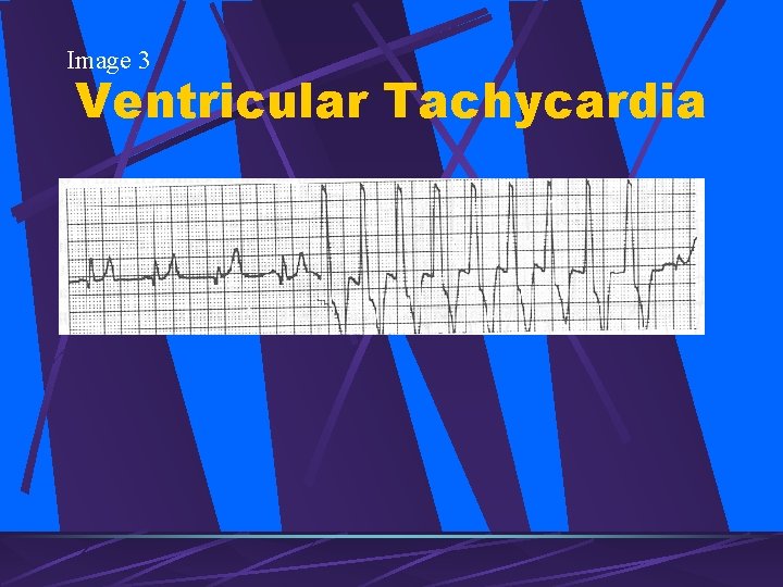 Image 3 Ventricular Tachycardia 