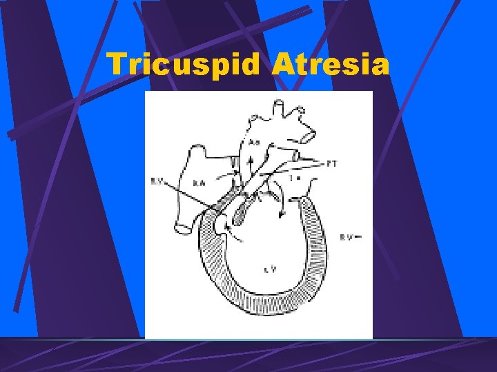 Tricuspid Atresia 