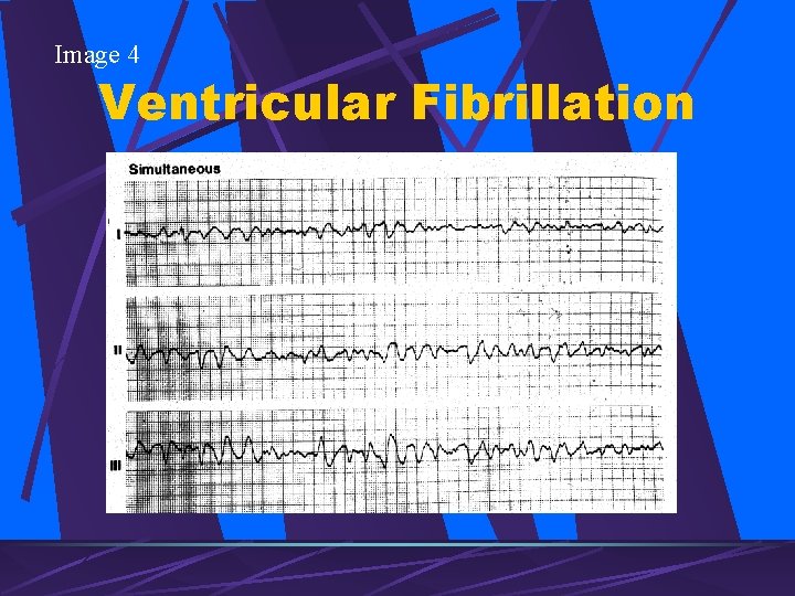 Image 4 Ventricular Fibrillation 