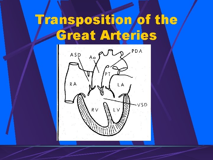 Transposition of the Great Arteries 