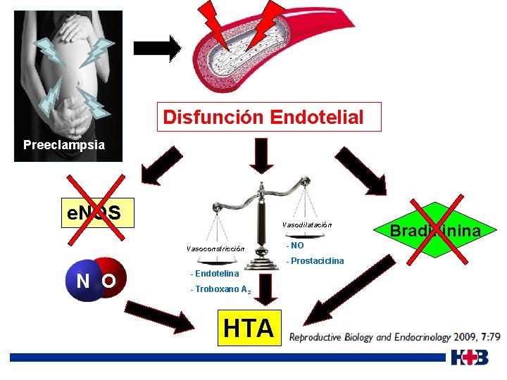 Disfunción Endotelial Preeclampsia e. NOS Vasodilatación Vasoconstricción - NO - Prostaciclina N O -