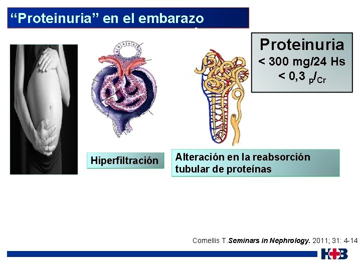 “Proteinuria” en el embarazo Proteinuria < 300 mg/24 Hs < 0, 3 p/Cr Hiperfiltración