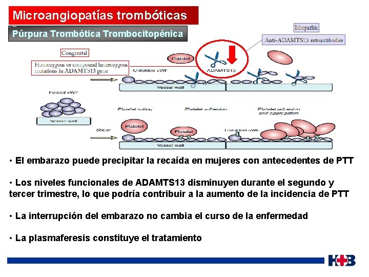 Microangiopatías trombóticas Púrpura Trombótica Trombocitopénica • El embarazo puede precipitar la recaída en mujeres