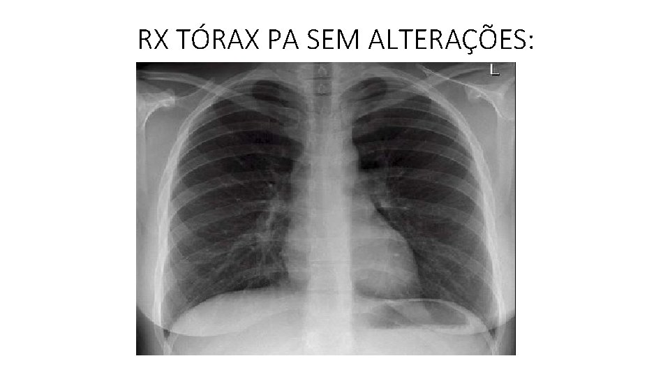 RX TÓRAX PA SEM ALTERAÇÕES: RX TÓRAX PA SEM ALTERAÇÕES: