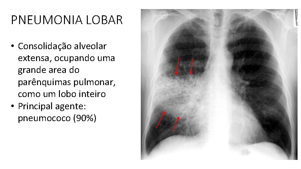 PNEUMONIA LOBAR • Consolidação alveolar extensa, ocupando uma grande area do parênquimas pulmonar, como PNEUMONIA LOBAR • Consolidação alveolar extensa, ocupando uma grande area do parênquimas pulmonar, como