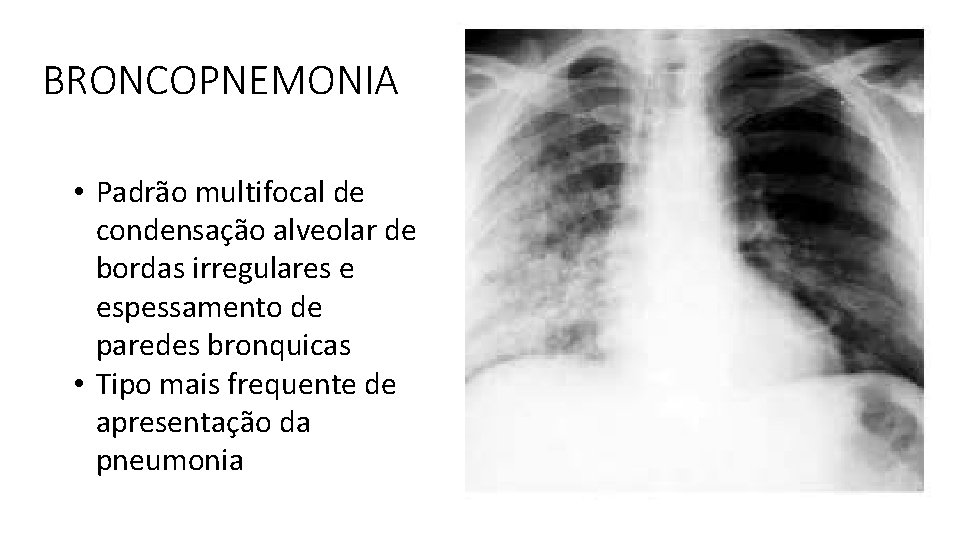 BRONCOPNEMONIA • Padrão multifocal de condensação alveolar de bordas irregulares e espessamento de paredes BRONCOPNEMONIA • Padrão multifocal de condensação alveolar de bordas irregulares e espessamento de paredes
