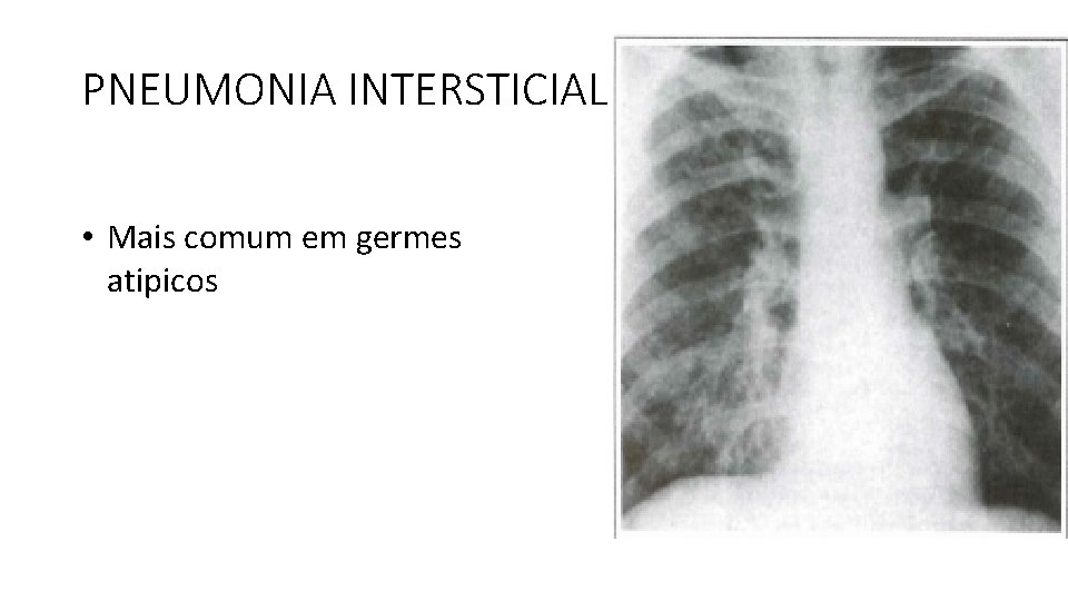 PNEUMONIA INTERSTICIAL • Mais comum em germes atipicos PNEUMONIA INTERSTICIAL • Mais comum em germes atipicos