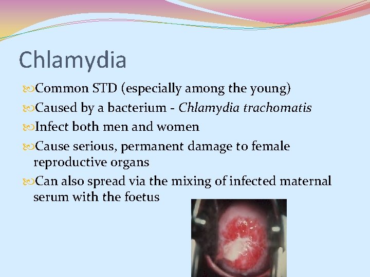 Chlamydia Common STD (especially among the young) Caused by a bacterium - Chlamydia trachomatis Chlamydia Common STD (especially among the young) Caused by a bacterium - Chlamydia trachomatis