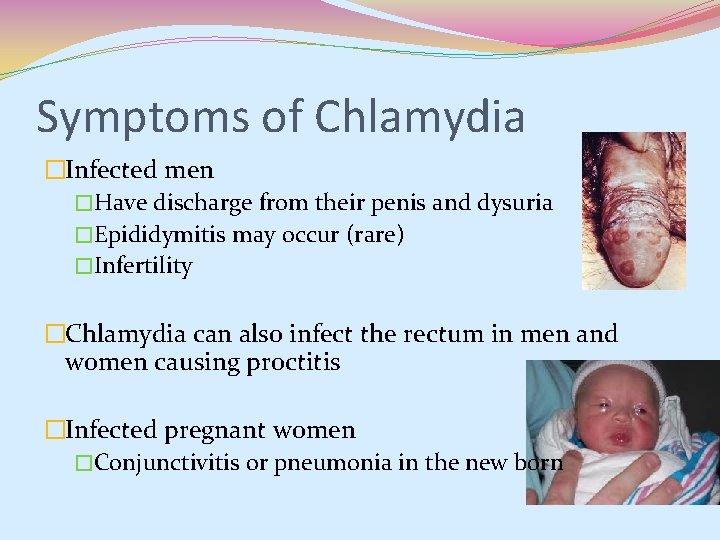 Symptoms of Chlamydia �Infected men �Have discharge from their penis and dysuria �Epididymitis may Symptoms of Chlamydia �Infected men �Have discharge from their penis and dysuria �Epididymitis may