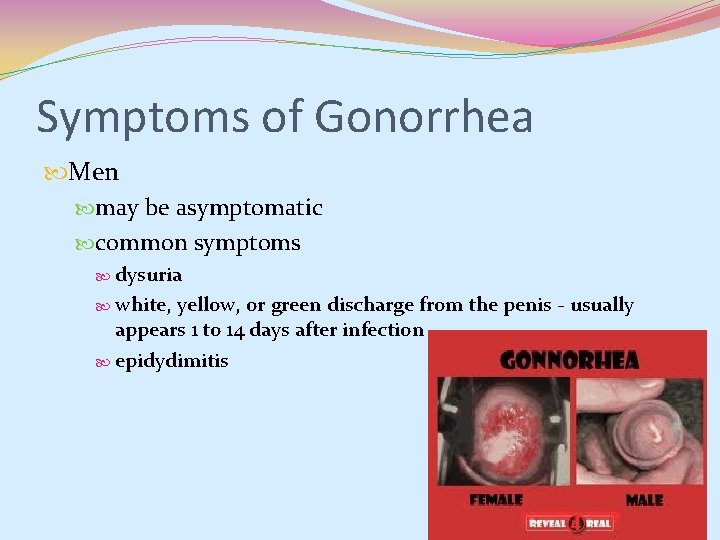 Symptoms of Gonorrhea Men may be asymptomatic common symptoms dysuria white, yellow, or green Symptoms of Gonorrhea Men may be asymptomatic common symptoms dysuria white, yellow, or green