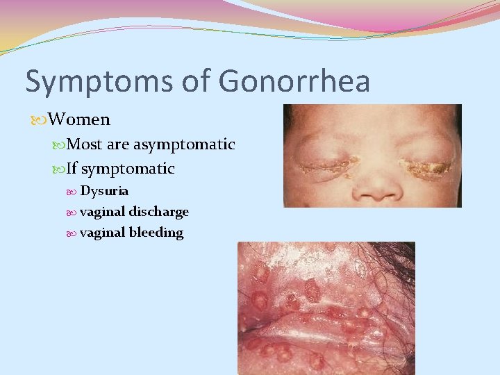Symptoms of Gonorrhea Women Most are asymptomatic If symptomatic Dysuria vaginal discharge vaginal bleeding Symptoms of Gonorrhea Women Most are asymptomatic If symptomatic Dysuria vaginal discharge vaginal bleeding
