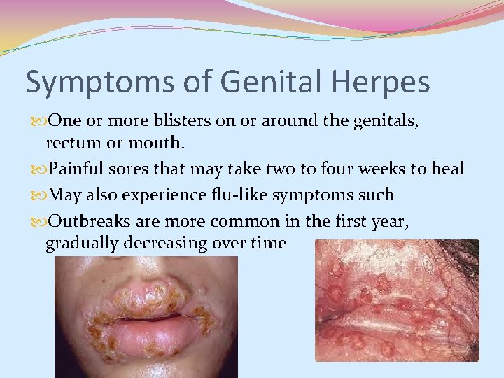 Symptoms of Genital Herpes One or more blisters on or around the genitals, rectum Symptoms of Genital Herpes One or more blisters on or around the genitals, rectum